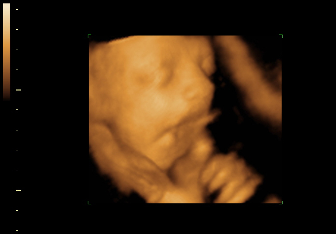 3D ultrasound image at 28 weeks